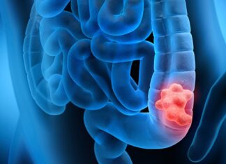 Campanha Março Azul alerta sobre riscos do câncer colorretal