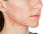 Cinco dicas para amenizar a acne e os efeitos causados por ela