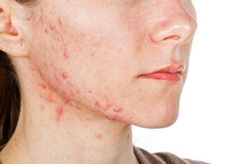 Cinco dicas para amenizar a acne e os efeitos causados por ela