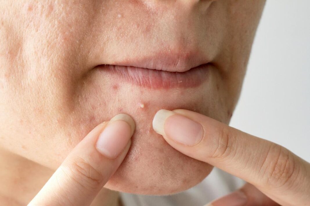 Como se livrar das marcas de acnes e espinhas com remédios caseiros