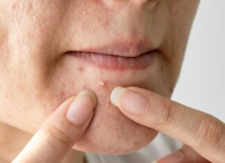 Como se livrar das marcas de acnes e espinhas com remédios caseiros Como se livrar das marcas de acnes e espinhas com remédios caseiros