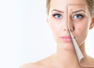 3 máscaras caseiras para remover marcas de acne e espinhas 3 máscaras caseiras para remover marcas de acne e espinhas