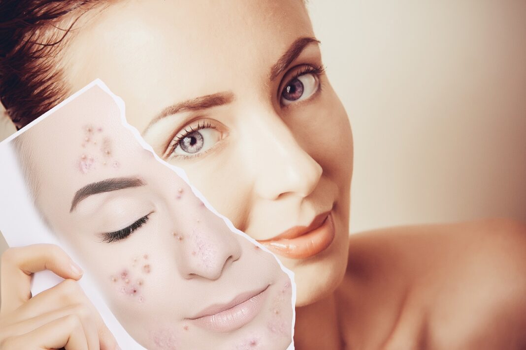 Três truques para evitar acne e erupções constantes na pele