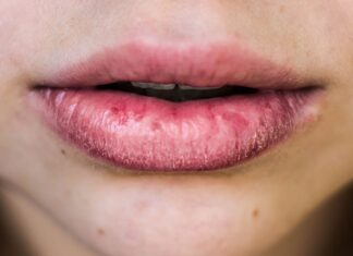 Preocupada com lábios rachados? Essas dicas podem te ajudar! Preocupada com lábios rachados? Essas dicas podem te ajudar!