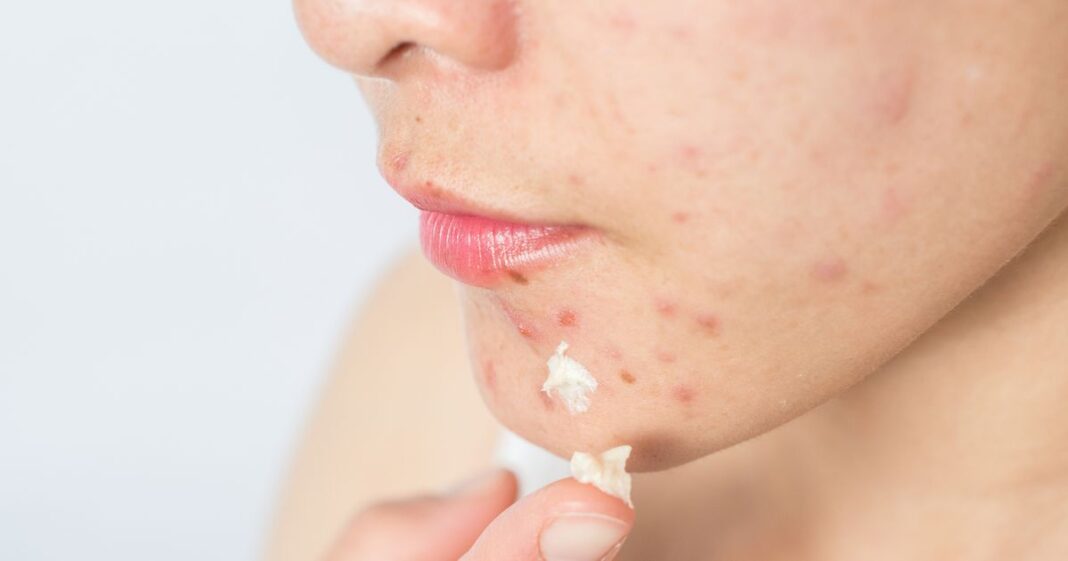 Saiba como clarear cicatrizes de acne com remédios caseiros