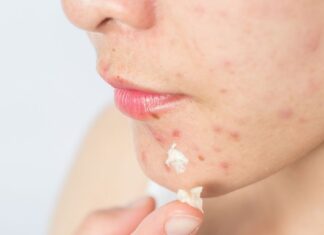 Saiba como clarear cicatrizes de acne com remédios caseiros Saiba como clarear cicatrizes de acne com remédios caseiros
