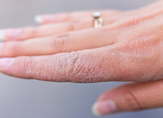 Evite a descamação da pele com estes remédios caseiros Evite a descamação da pele com estes remédios caseiros