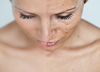 5 remédios caseiros para se livrar das manchas escuras da pele 5 remédios caseiros para se livrar das manchas escuras da pele